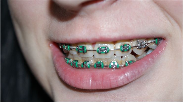 Can you Chewing Gum with Braces